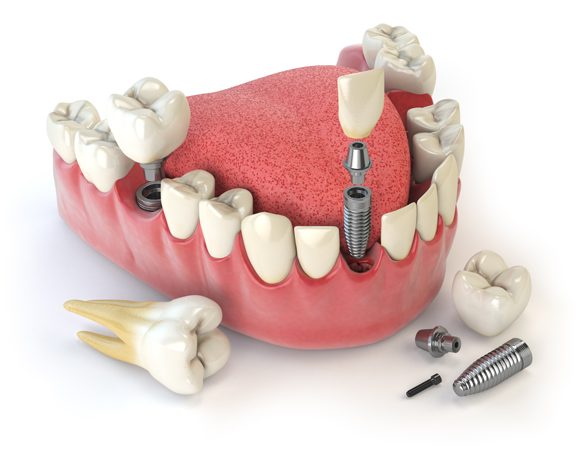 Implantes Dentales de Titanio